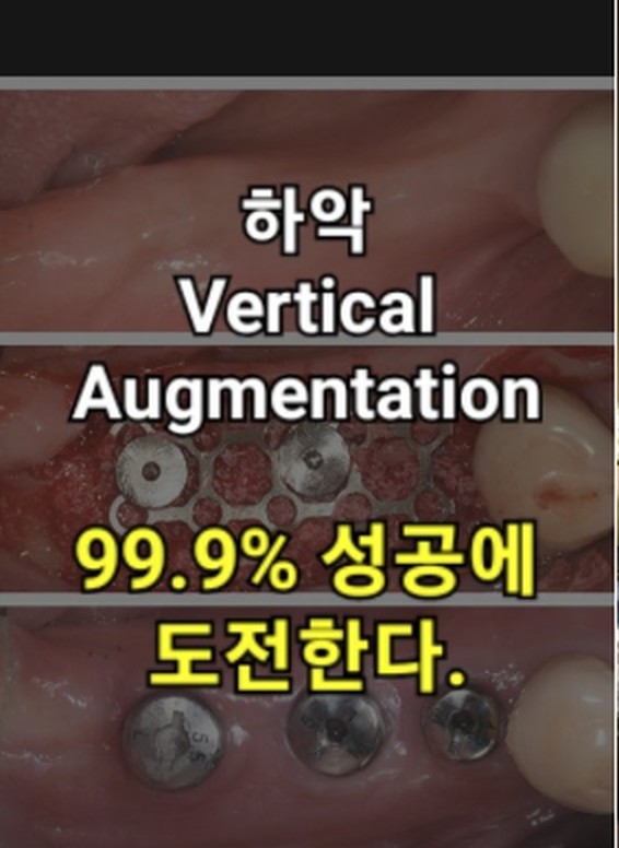 하악 Vertical Augmentation, 99.9% 성공에 도전한다