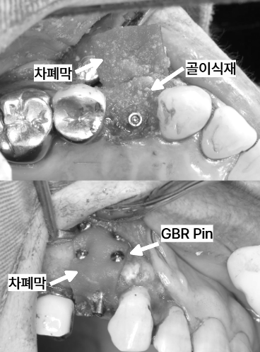GBR 차폐막과 핀을 적용한 수술 사진