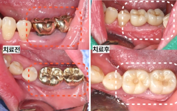 임플란트와 골이식·잇몸재건을 함께 진행한 임상 기록