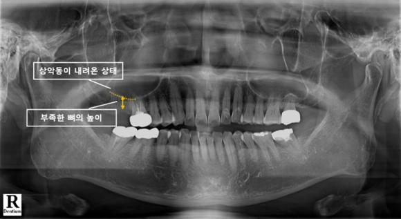 상악동과 치조골 높이를 확인하는 파노라마 영상