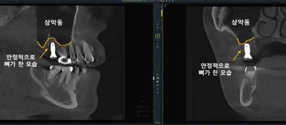 상악동거상술 진료 기록 영상