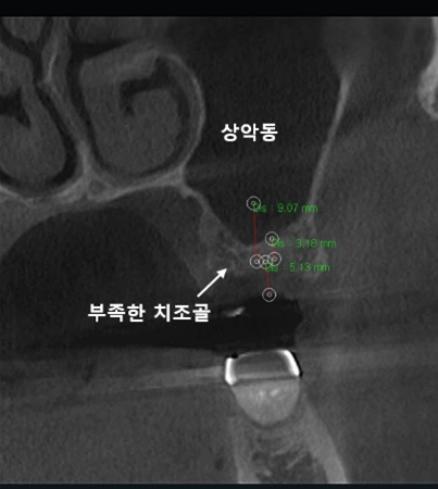 상악동과 부족한 치조골의 단면 영상