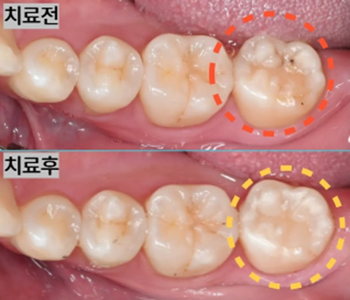 어금니 레진빌드업 치료 전후 비교