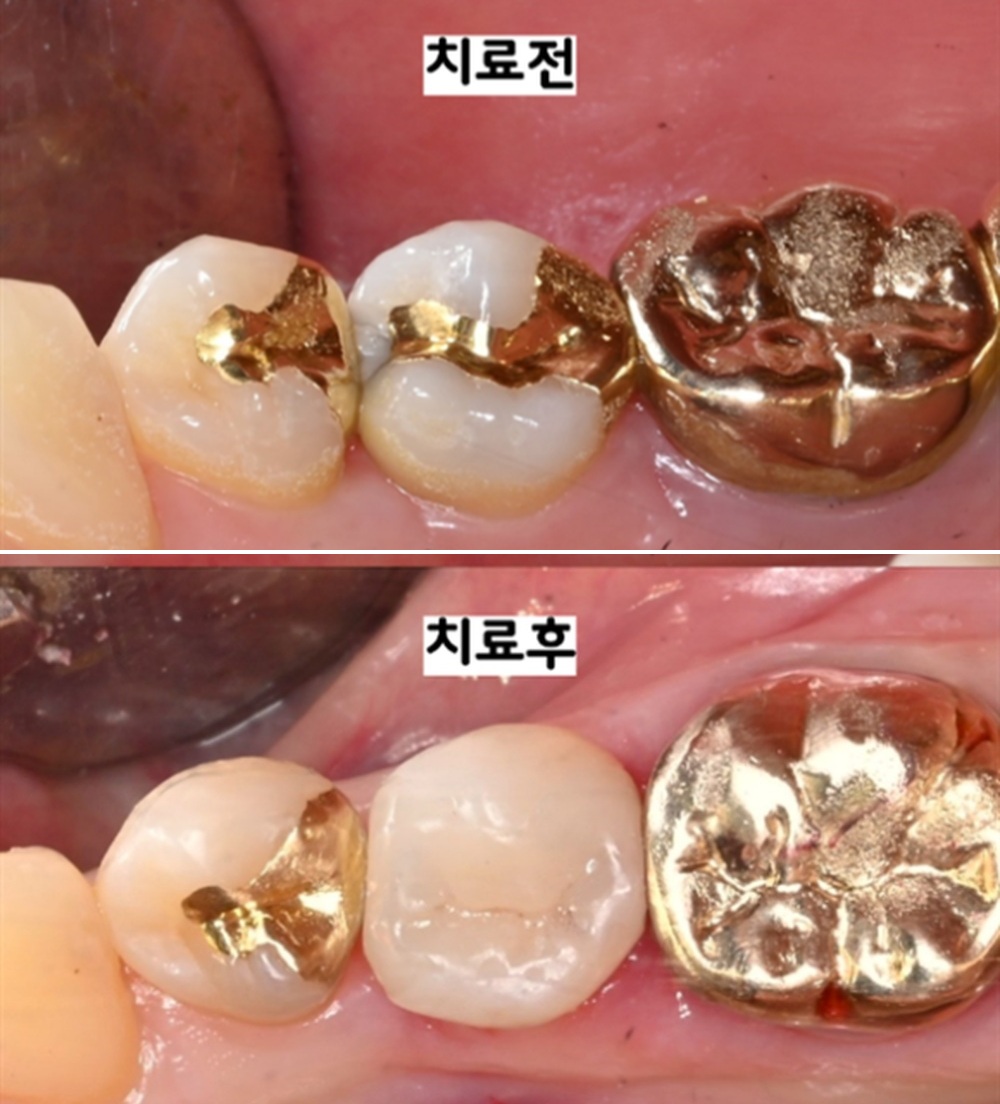 늘푸른치과 예전에 떼운 치아가 깨졌다면? MTA 후 인레이로 다시 치료한 사례 — 치료 전 및 치료 후 실제 사진