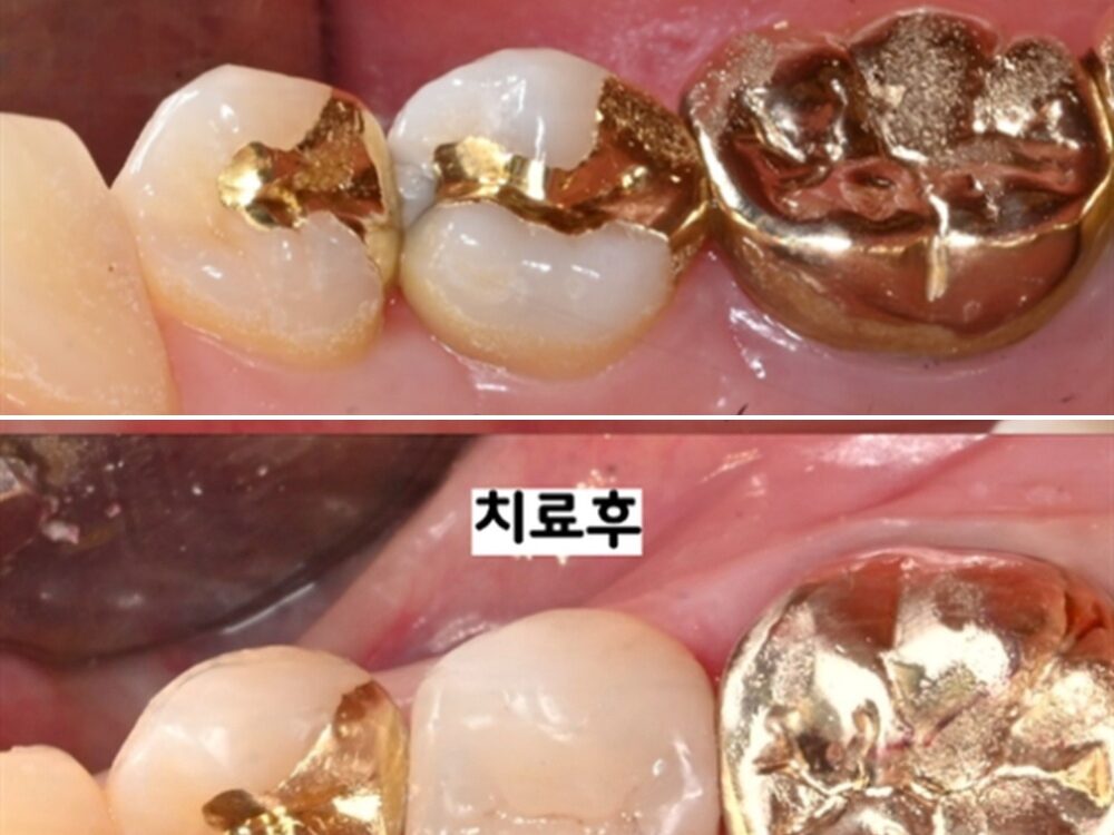 늘푸른치과 예전에 떼운 치아가 깨졌다면? MTA 후 인레이로 다시 치료한 사례 — 치료 전 및 치료 후 실제 사진