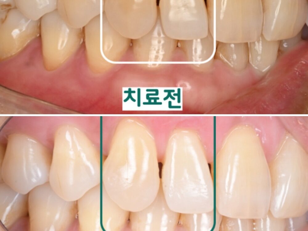 늘푸른치과 치아 시림, 치은이식술로 개선한 사례 — 치료 전 및 치료 후 실제 사진