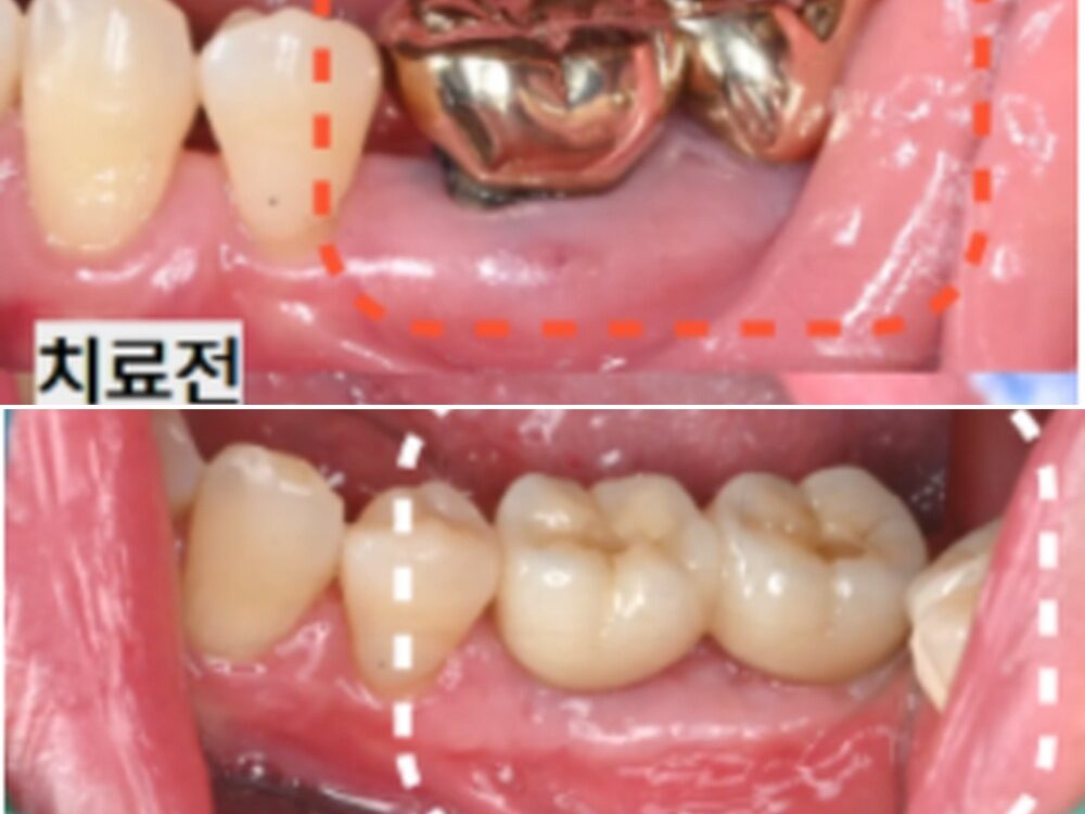 늘푸른치과 임플란트, 발치와 골이식부터 잇몸이식까지 함께 진행한 사례 — 치료 전 및 치료 후 실제 사진