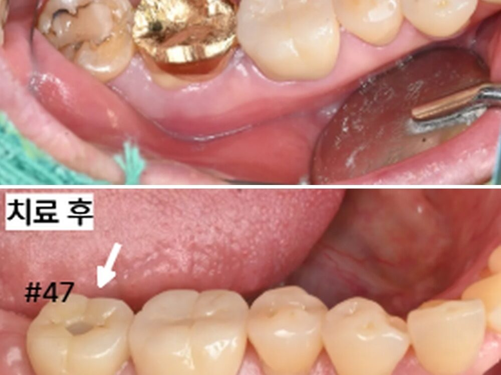 늘푸른치과 골이식·잇몸이식 없이 APF만으로 진행한 임플란트 사례 — 치료 전 및 치료 후 실제 사진
