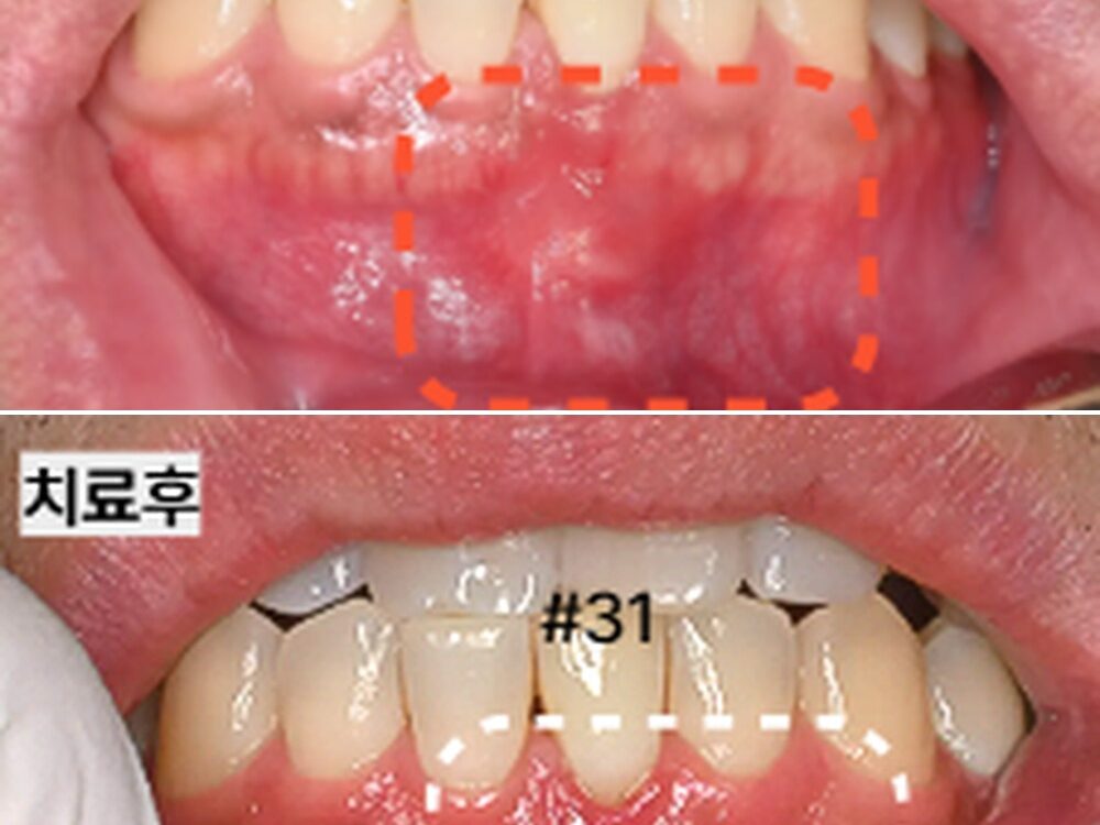 늘푸른치과 신경치료 후에도 반복되는 염증, 치근단절제술로 치료한 사례 — 치료 전 및 치료 후 실제 사진