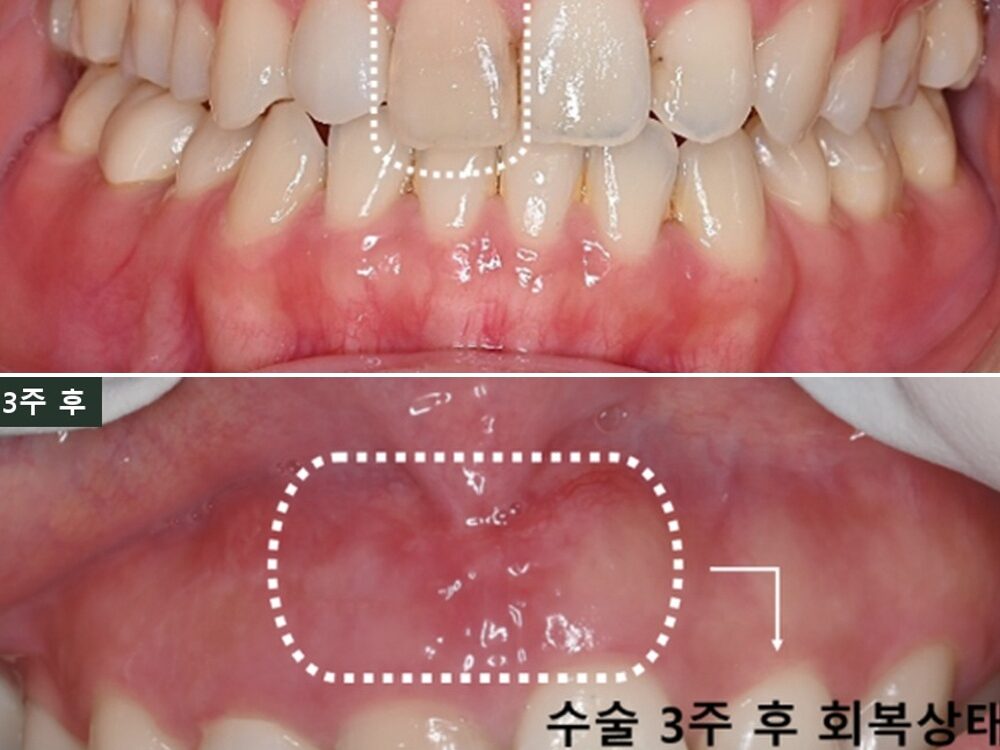 늘푸른치과 앞니 색 변한 치아, 단순 변색이 아니었던 치근단절제술 사례 — 치료 전 및 수술 3주 후 실제 사진