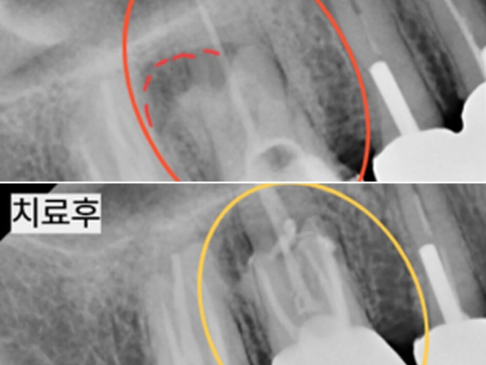 늘푸른치과 부산늘푸른치과 5근관 재신경치료와 치아 정출 크라운 치료 사례. — 치료 전 및 치료 후 실제 사진