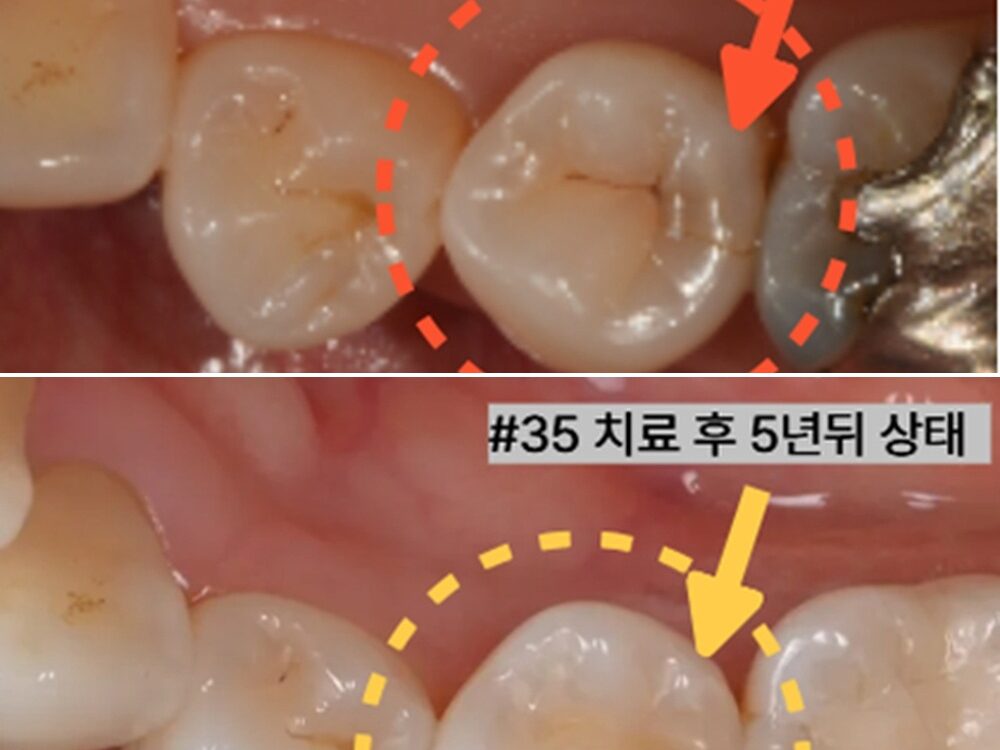 늘푸른치과 씹을 때 아픈 왼쪽 아래 어금니 신경치료 와 크라운 대신 mta 적용과 레진 치료를 한 사례 부산 늘푸른치과 — 치료 전 및 치료 5개월 후 실제 사진