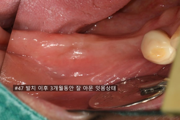 늘푸른치과 치료사례 - 남천동치과 임플란트, 티타늄 메쉬를 이용한 뼈이식으로 오래 쓰는 치료 - 사진 6