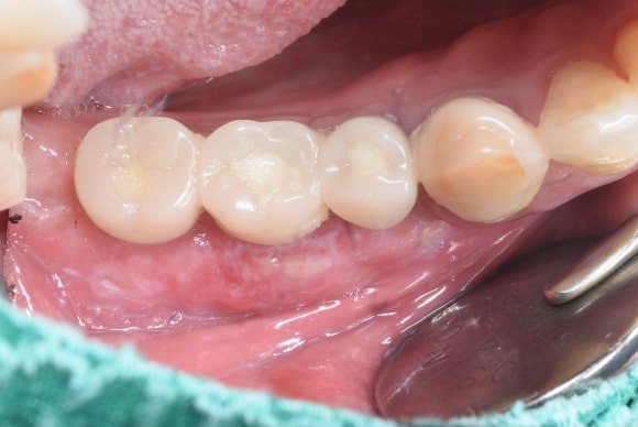 늘푸른치과 치료사례 - 용호동치과 Titanium Mesh를 이용한 임플란트 수술 후 FGG(유리 치은 이식술) - 사진 6