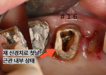 늘푸른치과 치료사례 - 광안동치과 씌운 치아에서 냄새가 나요. 크라운 제거 후 재치료, 임플란트 식립과 뼈이식, 치은이식술 과정 부산 늘푸른치과 - 사진 4