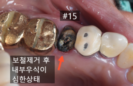늘푸른치과 치료사례 - 광안동치과 씌운 치아에서 냄새가 나요. 크라운 제거 후 재치료, 임플란트 식립과 뼈이식, 치은이식술 과정 부산 늘푸른치과 - 사진 5