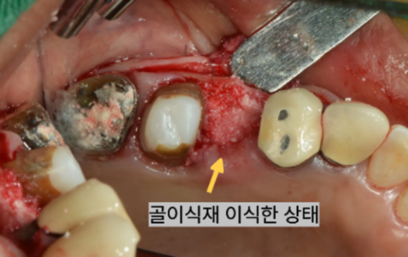 늘푸른치과 치료사례 - 광안동치과 씌운 치아에서 냄새가 나요. 크라운 제거 후 재치료, 임플란트 식립과 뼈이식, 치은이식술 과정 부산 늘푸른치과 - 사진 8