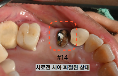 늘푸른치과 치료사례 - 광안동치과 씌운 치아에서 냄새가 나요. 크라운 제거 후 재치료, 임플란트 식립과 뼈이식, 치은이식술 과정 부산 늘푸른치과 - 사진 9