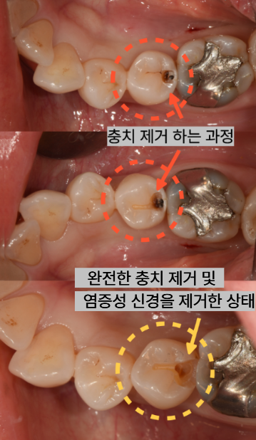 늘푸른치과 치료사례 - 씹을 때 아픈 왼쪽 아래 어금니 신경치료 와 크라운 대신 mta 적용과 레진 치료를 한 사례 부산 늘푸른치과 - 사진 4