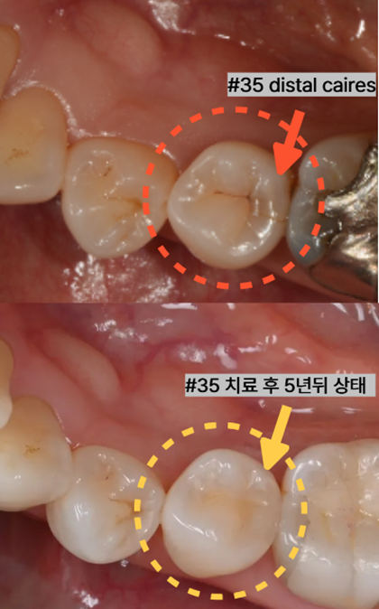 늘푸른치과 치료사례 - 씹을 때 아픈 왼쪽 아래 어금니 신경치료 와 크라운 대신 mta 적용과 레진 치료를 한 사례 부산 늘푸른치과 - 사진 9