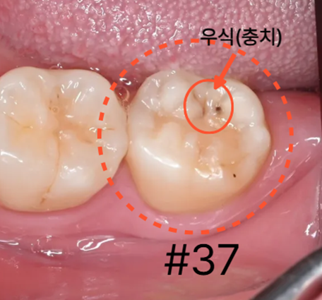 늘푸른치과 치료사례 - 치아를 보존하는 치료 레진빌드업 부산 늘푸른치과 - 사진 2