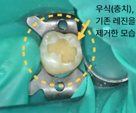 늘푸른치과 치료사례 - 치아를 보존하는 치료 레진빌드업 부산 늘푸른치과 - 사진 4