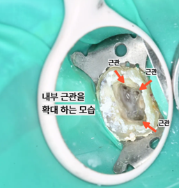 늘푸른치과 치료사례 - 신경치료 했는데 다시 아픈 이유, 숨겨진 4번째 신경관 재신경치료 사례 부산 늘푸른치과 - 사진 5