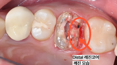 늘푸른치과 치료사례 - 신경치료 했는데 다시 아픈 이유, 숨겨진 4번째 신경관 재신경치료 사례 부산 늘푸른치과 - 사진 6