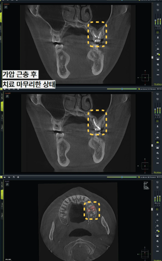늘푸른치과 치료사례 - 신경치료 했는데 다시 아픈 이유, 숨겨진 4번째 신경관 재신경치료 사례 부산 늘푸른치과 - 사진 9