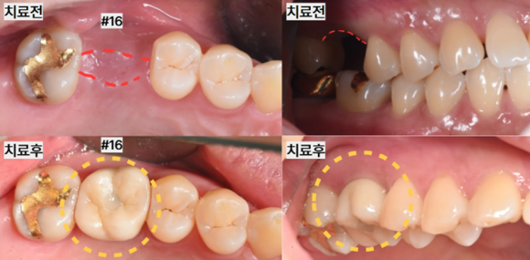 늘푸른치과 치료사례 - 상악 어금니 임플란트 뼈 부족할 때? 상악동거상술 치료 사례 부산 늘푸른치과 - 사진 13