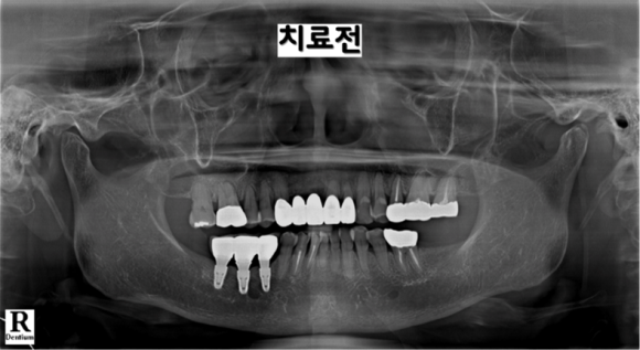 늘푸른치과 치료사례 - 앞니 임플란트 잇몸뼈 부족할 때 어떻게 치료할까요? 앞니 브릿지 흔들림 GBR 골이식 치료 사례 부산늘푸른치과 - 사진 14