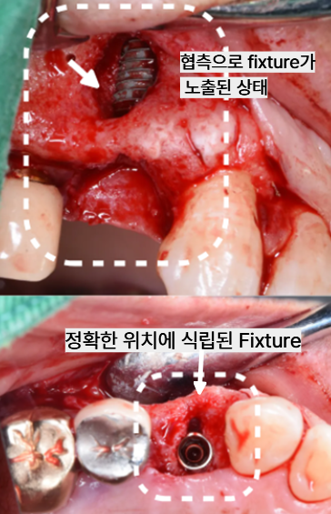 늘푸른치과 치료사례 - 잇몸에 고름 생겼다면? 발치 후 임플란트까지 진행된 사례 수영구치과 - 사진 6