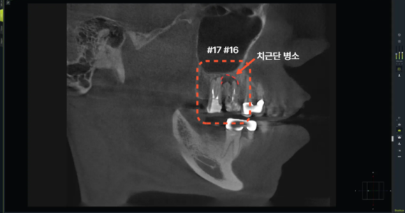 늘푸른치과 치료사례 - 부산늘푸른치과 5근관 재신경치료와 치아 정출 크라운 치료 사례. - 사진 2