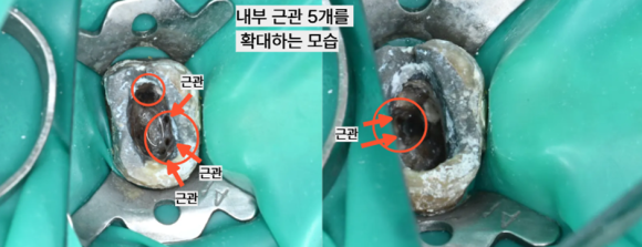 늘푸른치과 치료사례 - 부산늘푸른치과 5근관 재신경치료와 치아 정출 크라운 치료 사례. - 사진 8