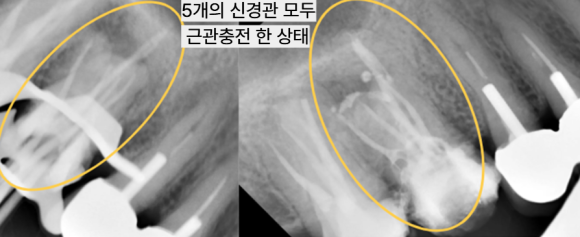 늘푸른치과 치료사례 - 부산늘푸른치과 5근관 재신경치료와 치아 정출 크라운 치료 사례. - 사진 9
