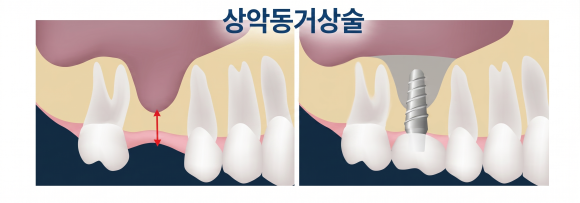 늘푸른치과 치료사례 - 상악동 수압거상술로 골이식 후 임플란트 사례. 남천동 늘푸른치과 - 사진 3