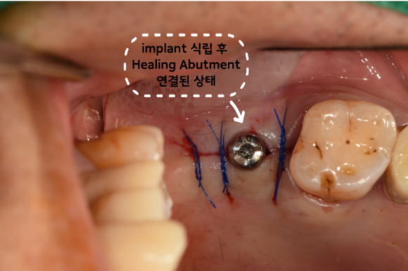 늘푸른치과 치료사례 - 상악동 수압거상술로 골이식 후 임플란트 사례. 남천동 늘푸른치과 - 사진 8