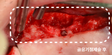 늘푸른치과 치료사례 - 흔들리는 어금니, 수압거상술을 활용한 임플란트 회복 사례 - 사진 7