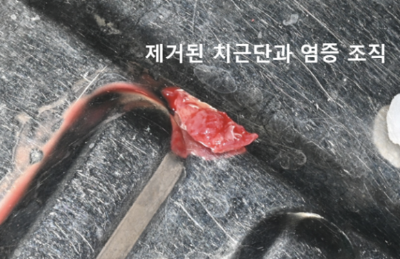 늘푸른치과 치료사례 - 앞니 색 변한 치아, 단순 변색이 아니었던 치근단절제술 사례 - 사진 7
