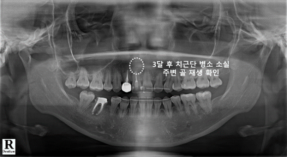 늘푸른치과 치료사례 - 앞니 색 변한 치아, 단순 변색이 아니었던 치근단절제술 사례 - 사진 15