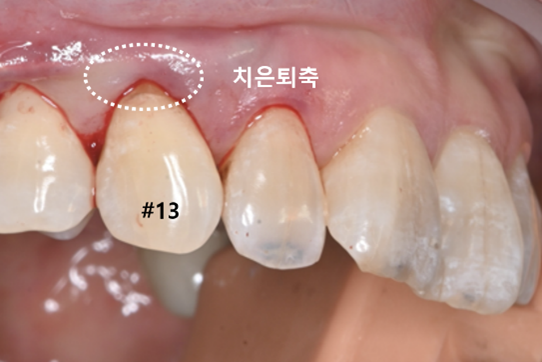 늘푸른치과 치료사례 - 내려가고 얇아진 잇몸, 결합조직이식술 사례- 수영로 늘푸른치과 - 사진 1