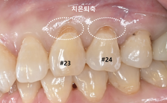 늘푸른치과 치료사례 - 내려가고 얇아진 잇몸, 결합조직이식술 사례- 수영로 늘푸른치과 - 사진 2