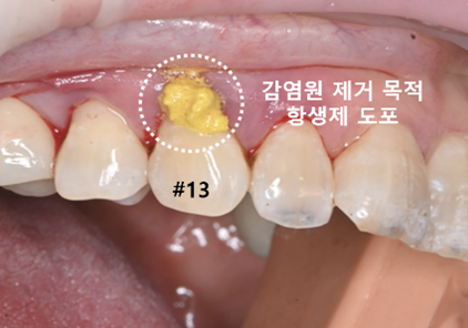 늘푸른치과 치료사례 - 내려가고 얇아진 잇몸, 결합조직이식술 사례- 수영로 늘푸른치과 - 사진 3