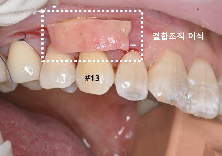 늘푸른치과 치료사례 - 내려가고 얇아진 잇몸, 결합조직이식술 사례- 수영로 늘푸른치과 - 사진 5