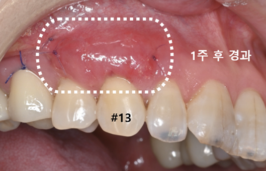 늘푸른치과 치료사례 - 내려가고 얇아진 잇몸, 결합조직이식술 사례- 수영로 늘푸른치과 - 사진 7