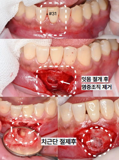 늘푸른치과 치료사례 - 신경치료 후에도 반복되는 염증, 치근단절제술로 치료한 사례 - 사진 5