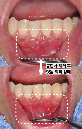늘푸른치과 치료사례 - 신경치료 후에도 반복되는 염증, 치근단절제술로 치료한 사례 - 사진 8