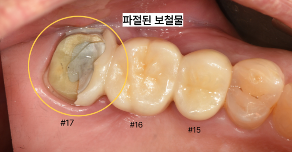 늘푸른치과 치료사례 - 교합력이 강해 보철 깨진 환자의 임플란트 치료 사례-용호동 늘푸른치과 - 사진 1