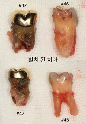 늘푸른치과 치료사례 - 심한 치조골 소실, 단계적 골유도재생술+유리치은이식술 사례 - 사진 3