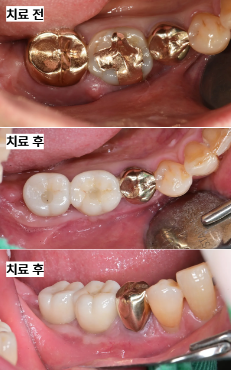 늘푸른치과 치료사례 - 심한 치조골 소실, 단계적 골유도재생술+유리치은이식술 사례 - 사진 11